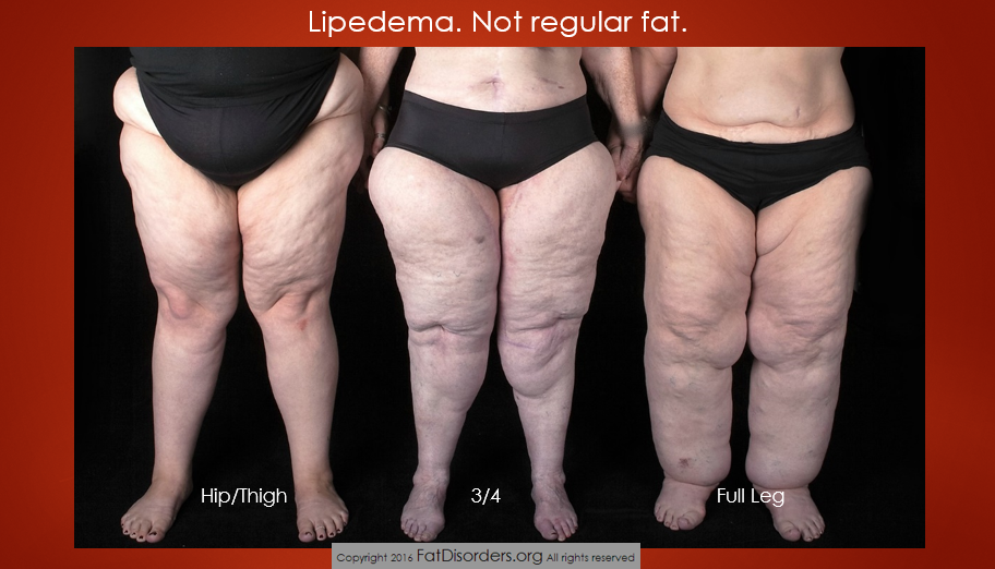 Various forms of lipedema