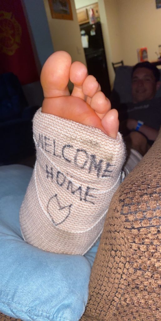 Travis Amato's ankle cast the night of his surgery 